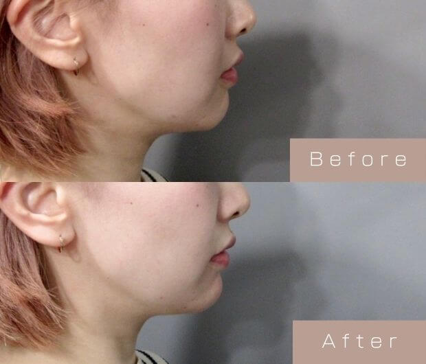 顎ヒアルロン酸