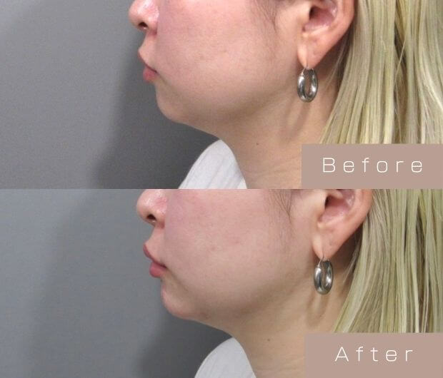 顎ヒアルロン酸