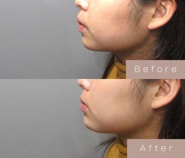 顎ヒアルロン酸