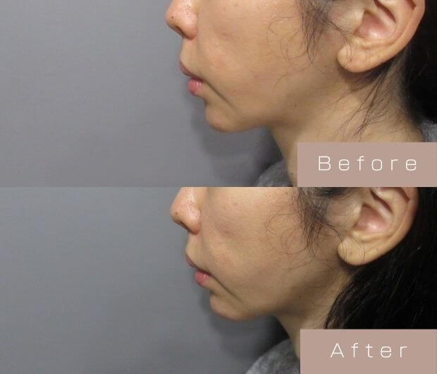 顎ヒアルロン酸