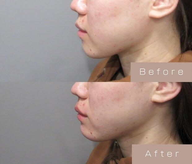 顎ヒアルロン酸