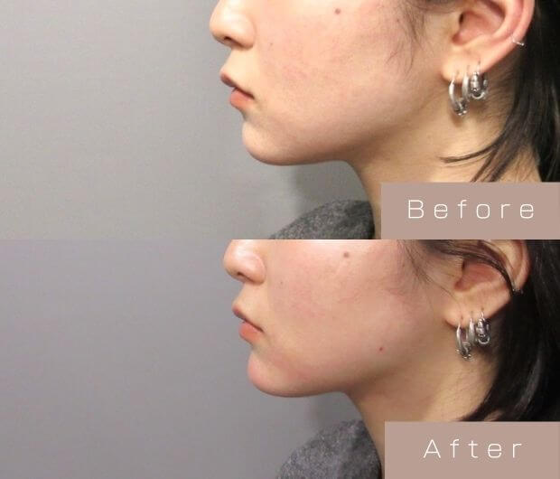 顎ヒアルロン酸