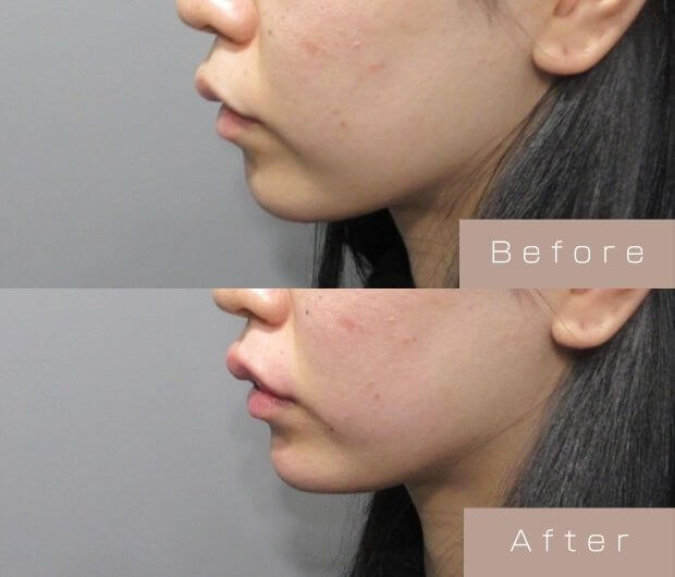 顎ヒアルロン酸