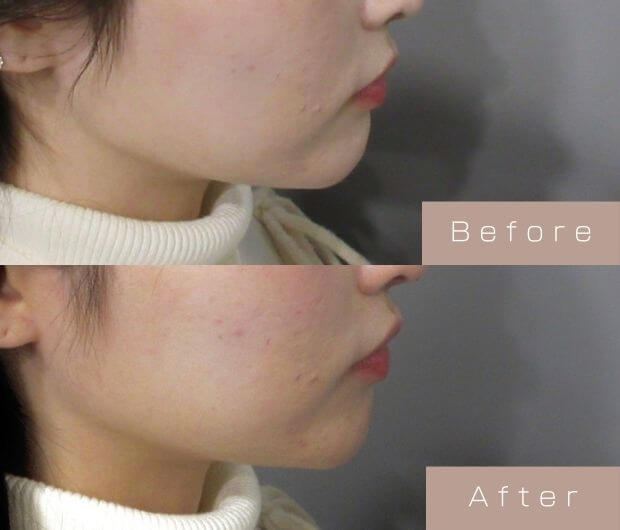 顎ヒアルロン酸