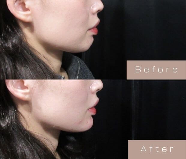 顎ヒアルロン酸