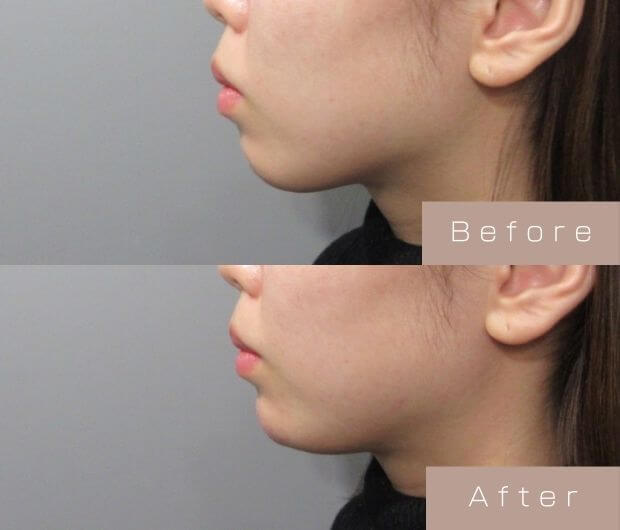 顎ヒアルロン酸