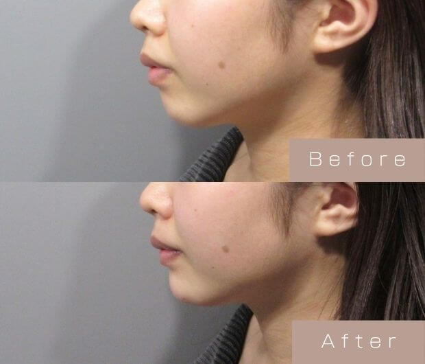 顎ヒアルロン酸