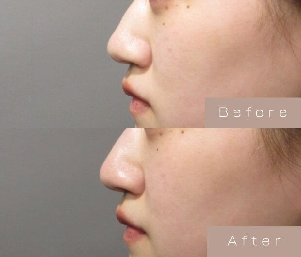 鼻ヒアルロン酸