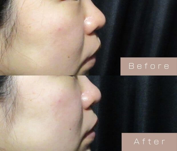 鼻ヒアルロン酸