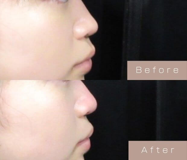 鼻ヒアルロン酸