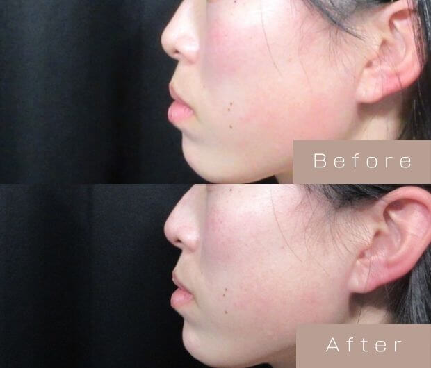 鼻ヒアルロン酸