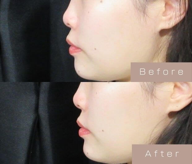 鼻ヒアルロン酸