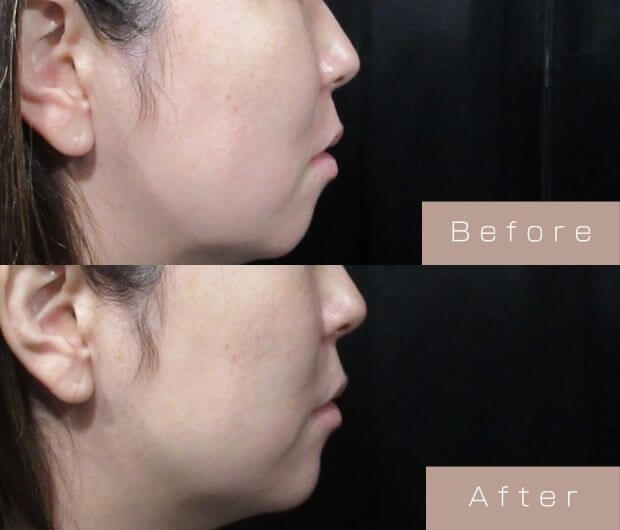 鼻ヒアルロン酸
