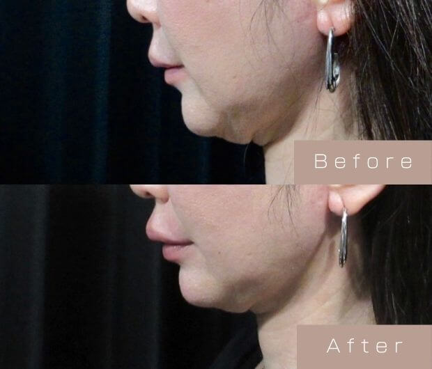 Eライン形成（Cカールリップ＋顎ヒアルロン酸）