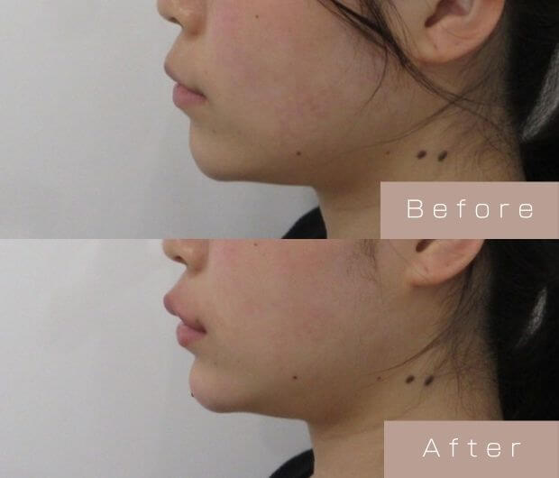 Eライン形成（Cカールリップ＋顎ヒアルロン酸）