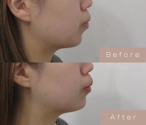 顎ヒアルロン酸