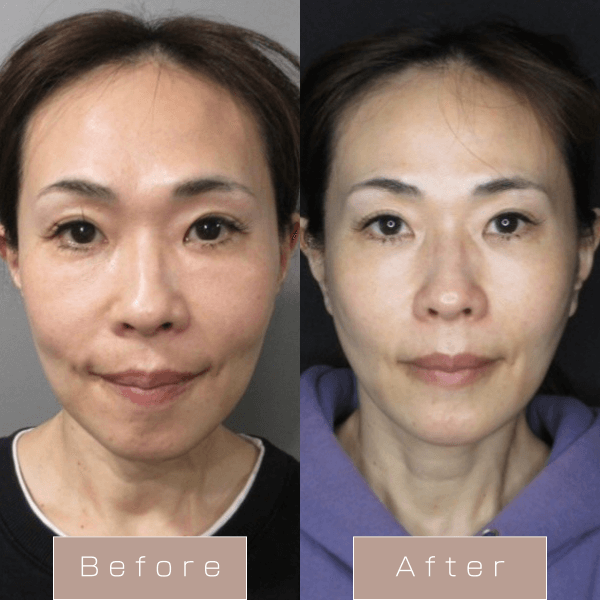 糸リフト（PDO）