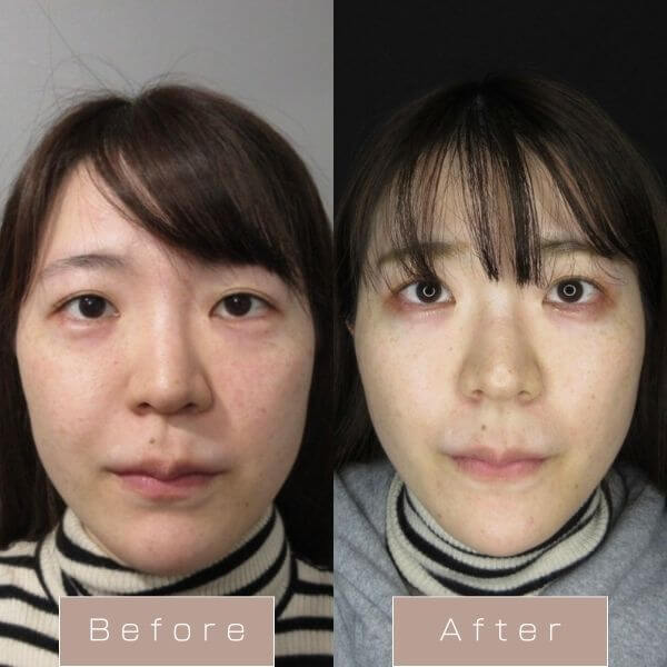 糸リフト（WPCL8本+カベリン4cc）