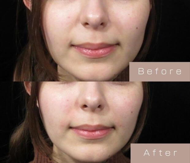 ほうれい線ヒアルロン酸