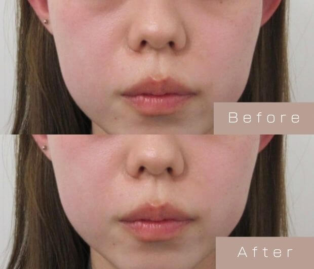 ほうれい線ヒアルロン酸