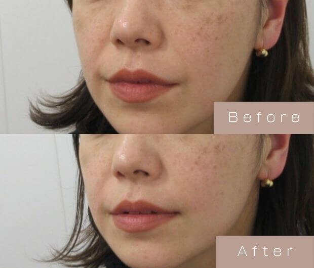 ほうれい線ヒアルロン酸