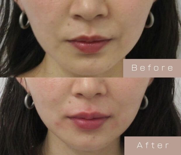 スマイルリップ