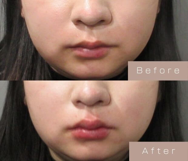 スマイルリップ