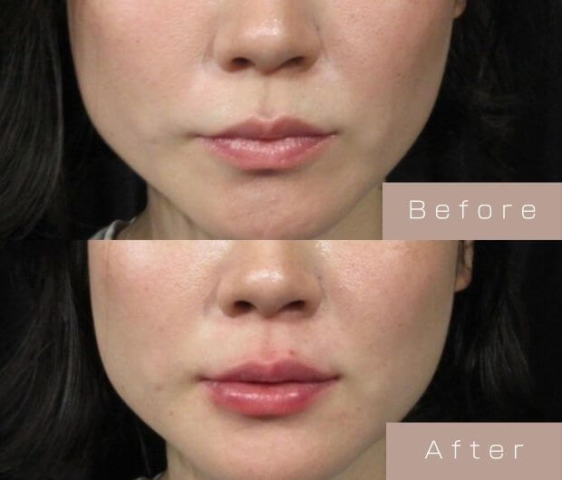 スマイルリップ