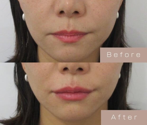 スマイルリップ