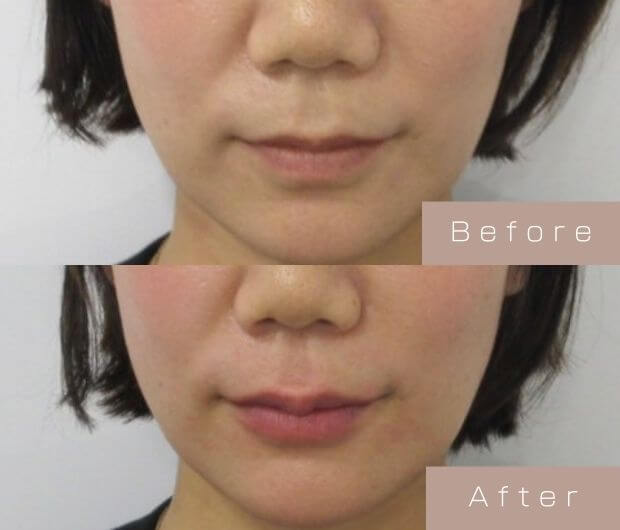 スマイルリップ