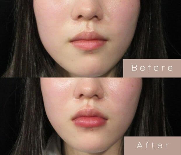 スマイルリップ