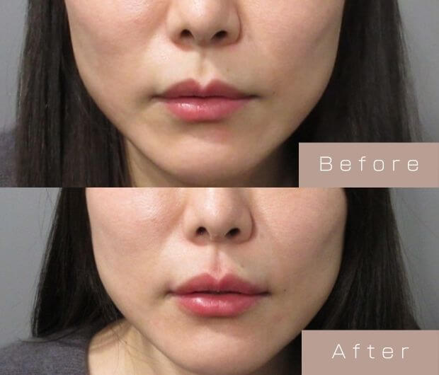 スマイルリップ