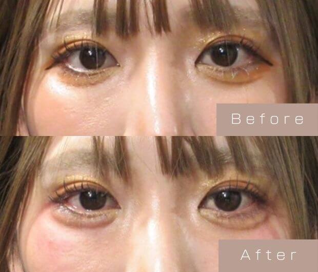 涙袋ヒアルロン酸