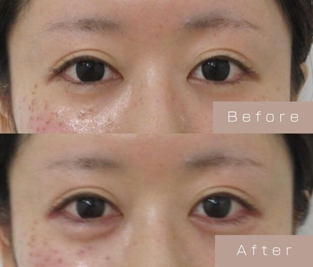 涙袋ヒアルロン酸