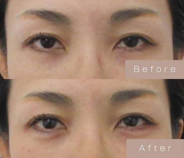 涙袋ヒアルロン酸