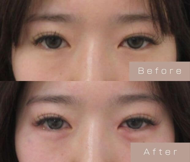 涙袋ヒアルロン酸