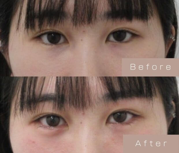 涙袋ヒアルロン酸