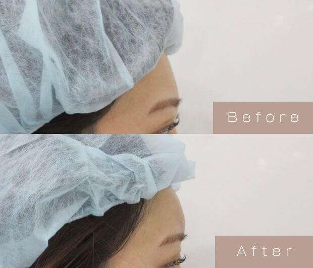 額ヒアルロン酸