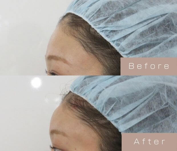 額ヒアルロン酸