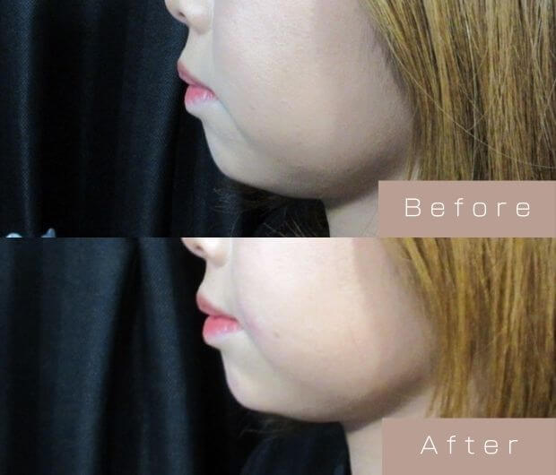 顎ヒアルロン酸