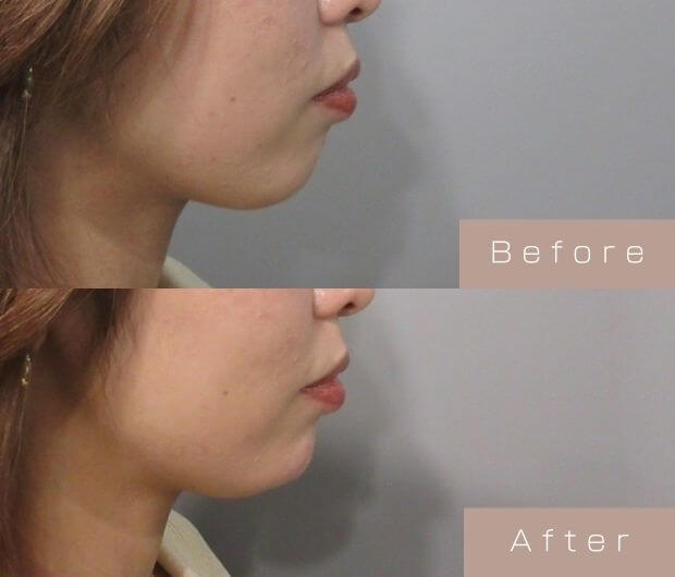 顎ヒアルロン酸