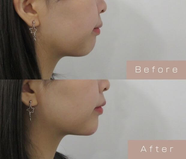 顎ヒアルロン酸