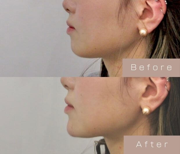 顎ヒアルロン酸