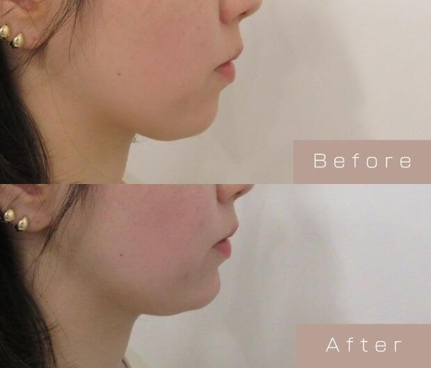 顎ヒアルロン酸