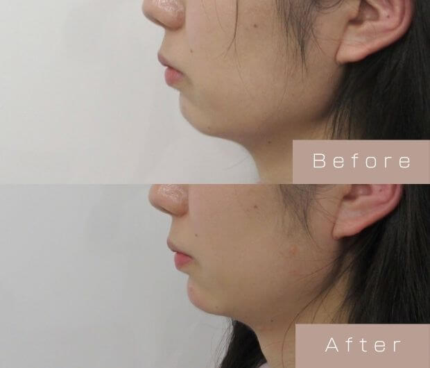 顎ヒアルロン酸