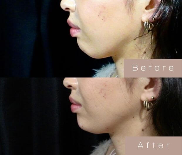 顎ヒアルロン酸