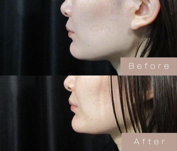 顎ヒアルロン酸