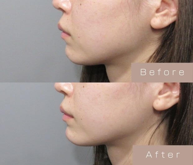 顎ヒアルロン酸