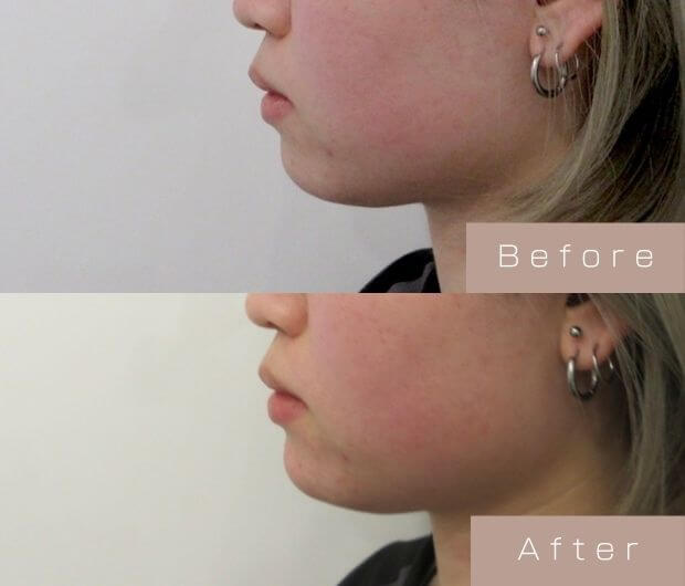 顎ヒアルロン酸