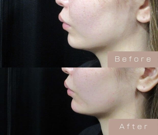 顎ヒアルロン酸